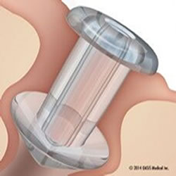 OASIS SOFT PLUG Flow Control Punctal Plugs - Box of 2