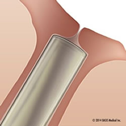 OASIS SOFT PLUG Collagen Punctal Plugs - Box of 60