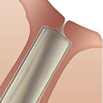 SOFT PLUG Collagen Plugs 60pk